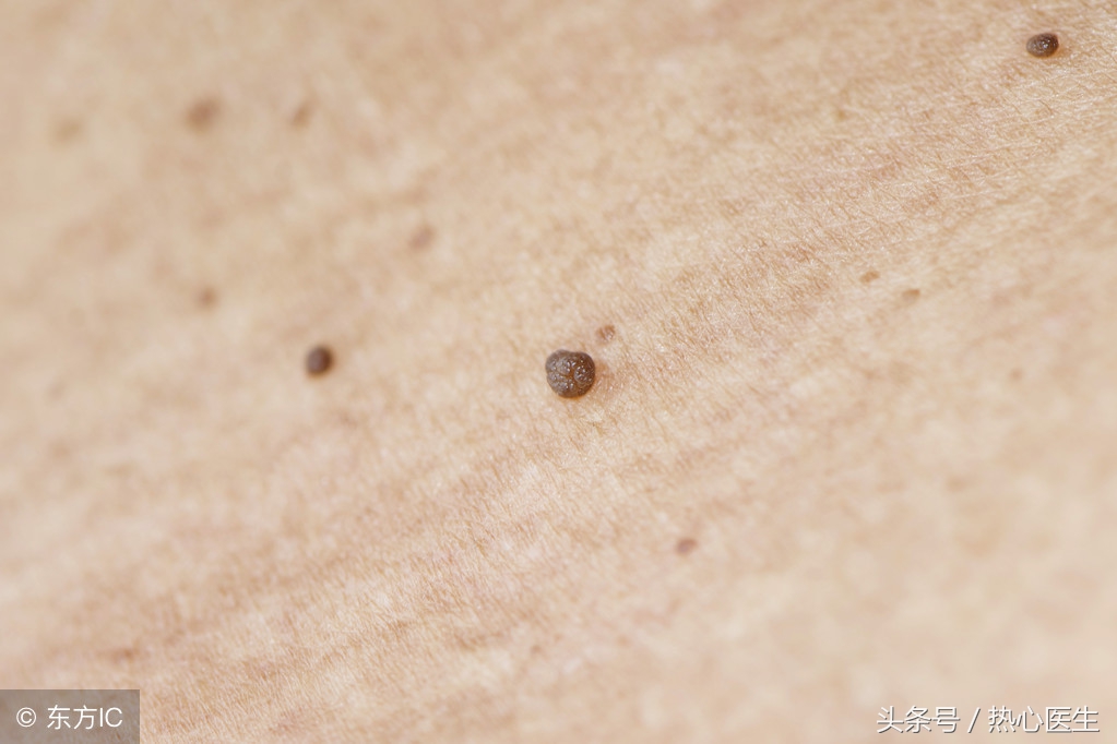 扁平疣怎样预防传染给别人,扁平疣怎么治疗和注意事项