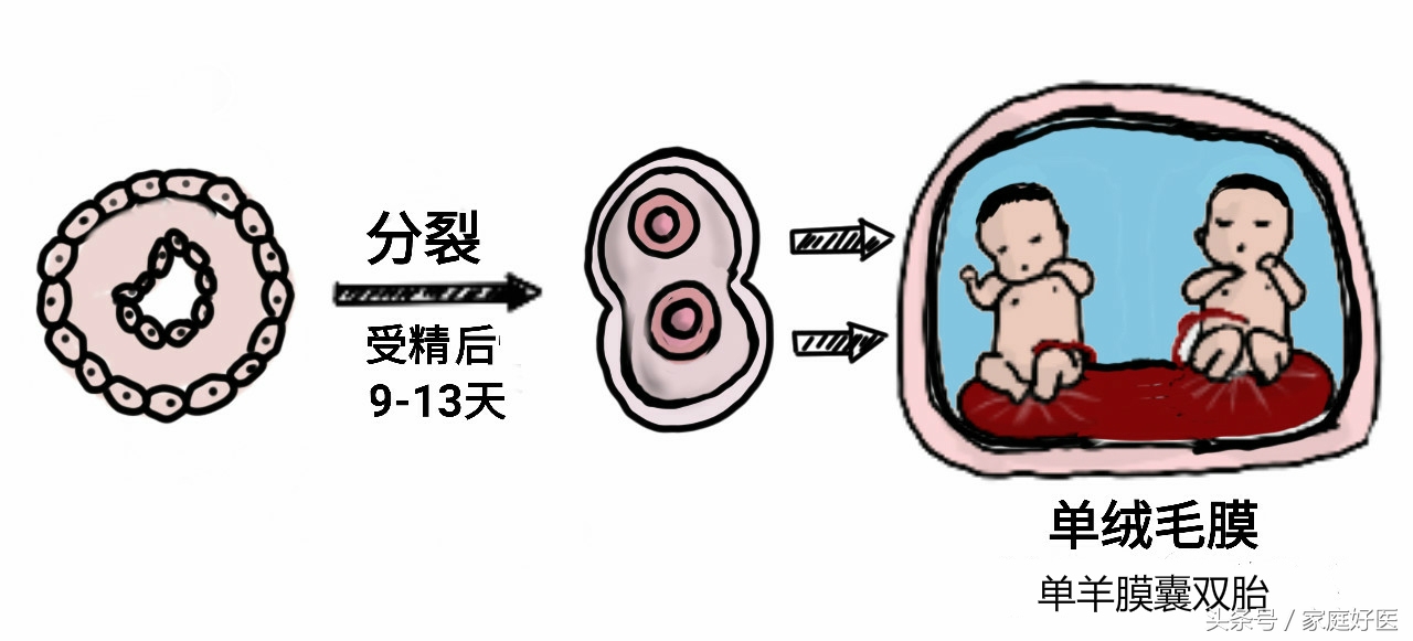 怀双胞胎一个会被另一个吸收吗,双胞胎吃掉另一个胎儿