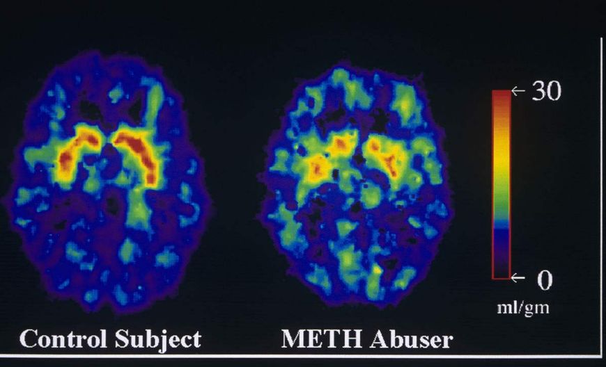 吸毒的人容易得抑郁症吗,吸毒的人会抑郁症么
