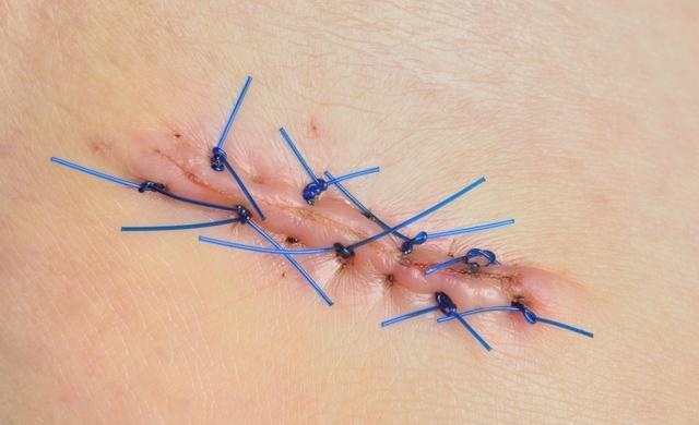 人体器官手术后愈合期要多久,手术内部伤口多久痊愈