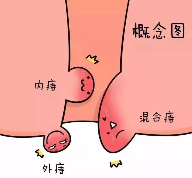 九痔是痔疮吗,痔疮到底是个啥为什么说十人九痔