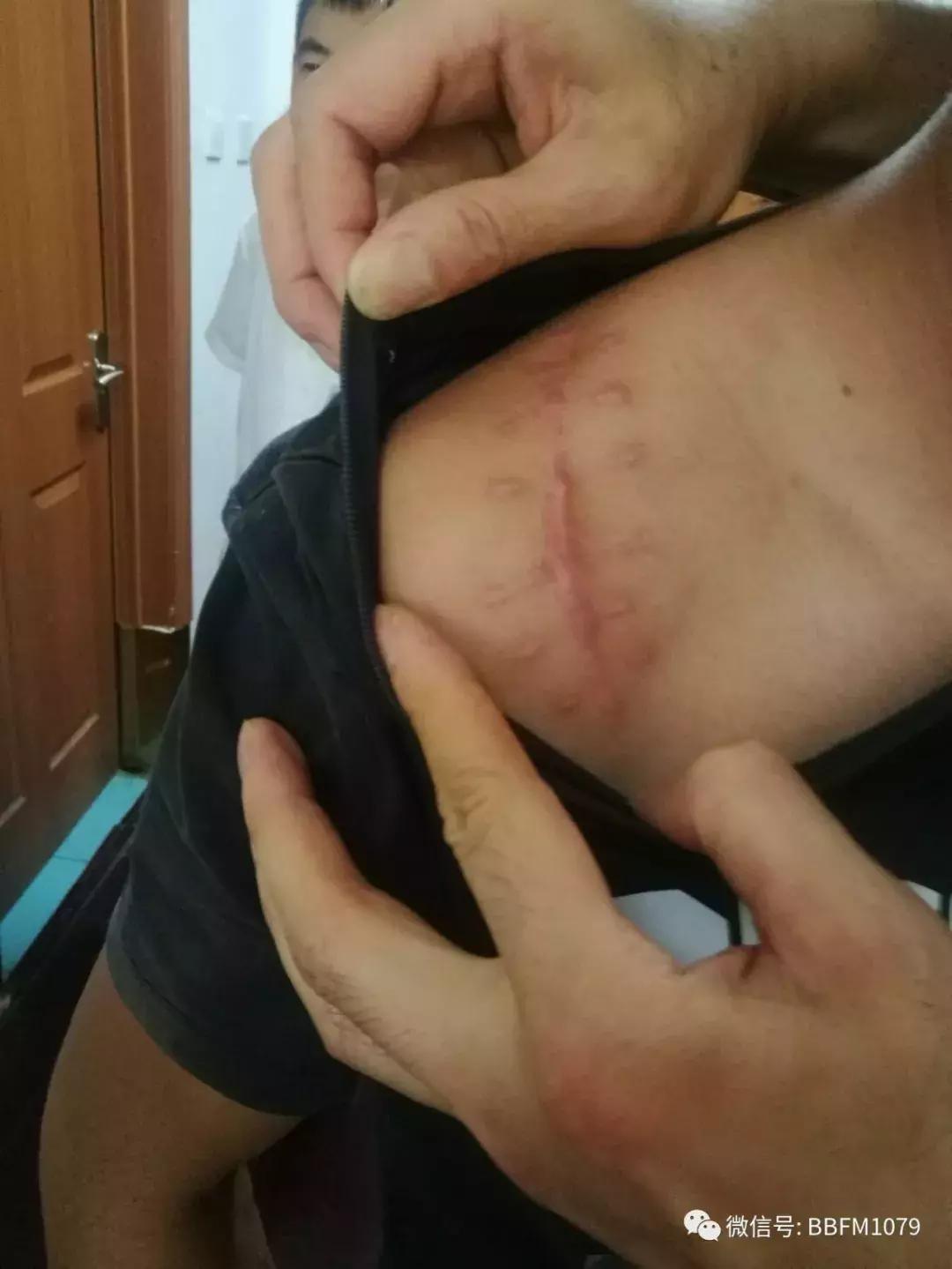 安徽8岁男童被砍死后续,2名孩子被拿斧头砍后续