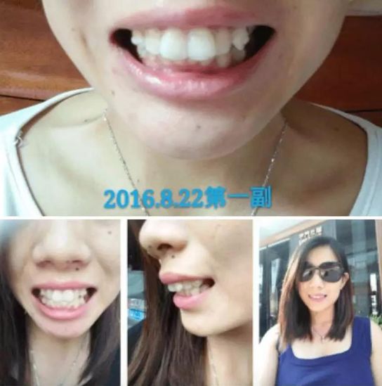 网上缺牙补贴是真的吗,缺牙人士看过来种牙补贴免费领