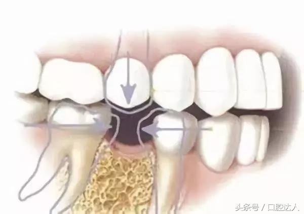 一颗牙怎么自己矫正,一颗牙怎么补那么多次才完成