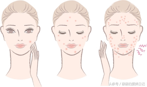 痘痘里面挤出来的白色东西是什么为什么痘痘里会挤出来白色物体