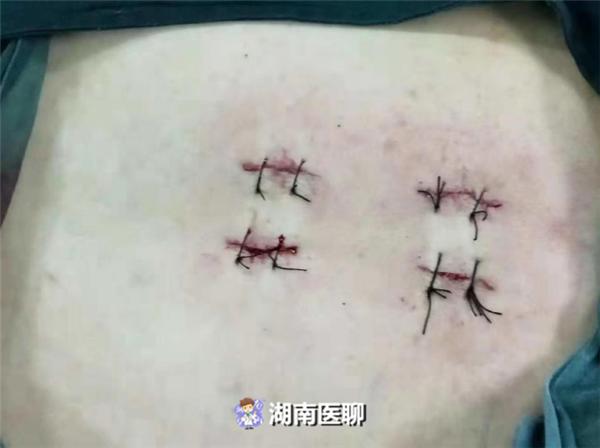 大妈摔倒路边无法动弹,70岁大妈腰直不起来