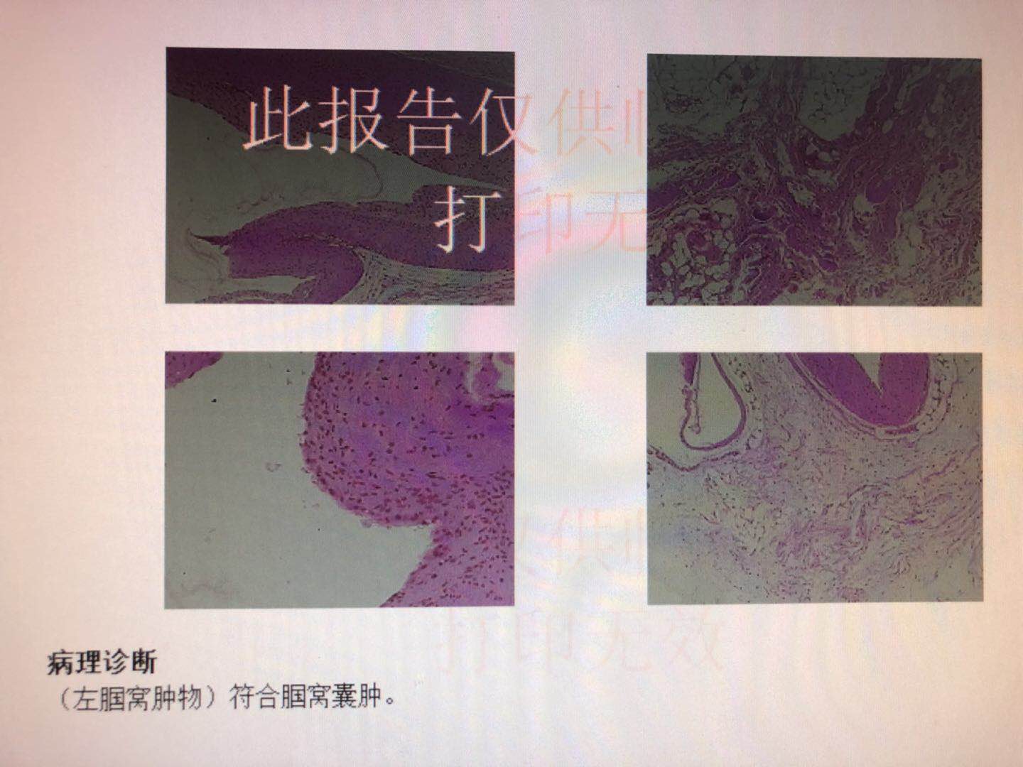 囊肿就是瘤吗,囊肿就是结节吗