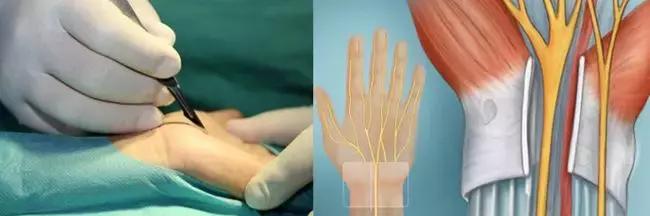 手麻、无力、肌肉萎缩？——你可能得了腕管综合征