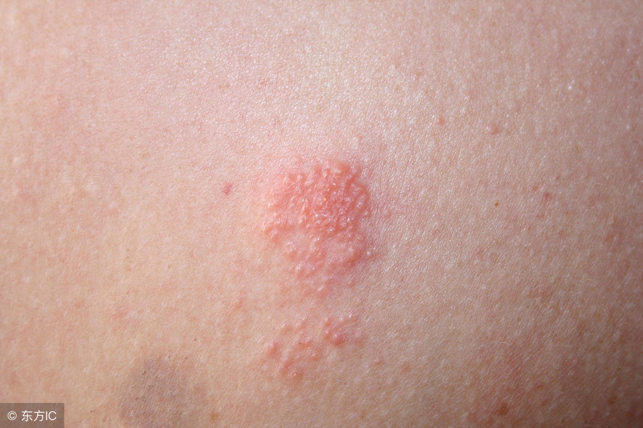 得了生殖器疱疹怎么治疗彻底有效,得了生殖器疱疹怎么治疗效果好