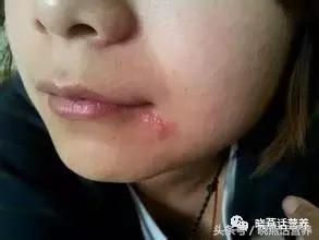 烂嘴角的饮食注意事项,烂嘴角怎么调理