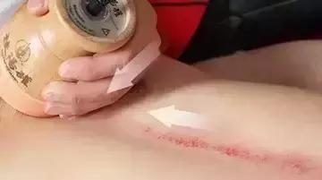 刮痧治疗感冒的操作流程,风寒感冒刮痧哪里效果最好图解