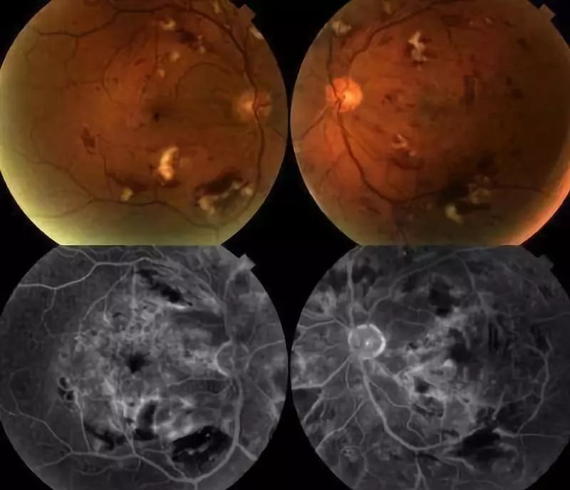 鼻咽癌放疗后视力下降,鼻咽癌放疗后视力模糊怎么治疗