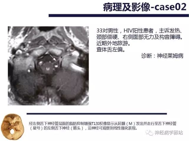 舌下神经和舌咽神经的解剖图,颊神经舌神经解剖图