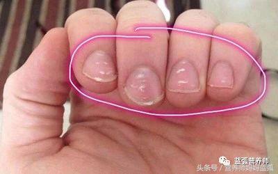 宝宝指甲白斑、凹陷、薄脆、倒刺、分层……原来是这么回事！