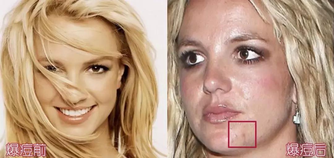 战痘的四个小方法,战痘女孩的秘笈