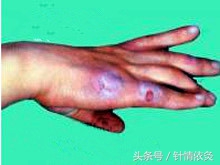 冻疮针灸,穴位治冻疮