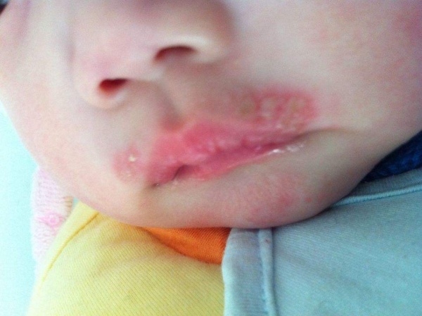 莫匹罗星软膏可以治疗嘴角起泡吗,孩子经常嘴角烂嘴角起泡怎么办