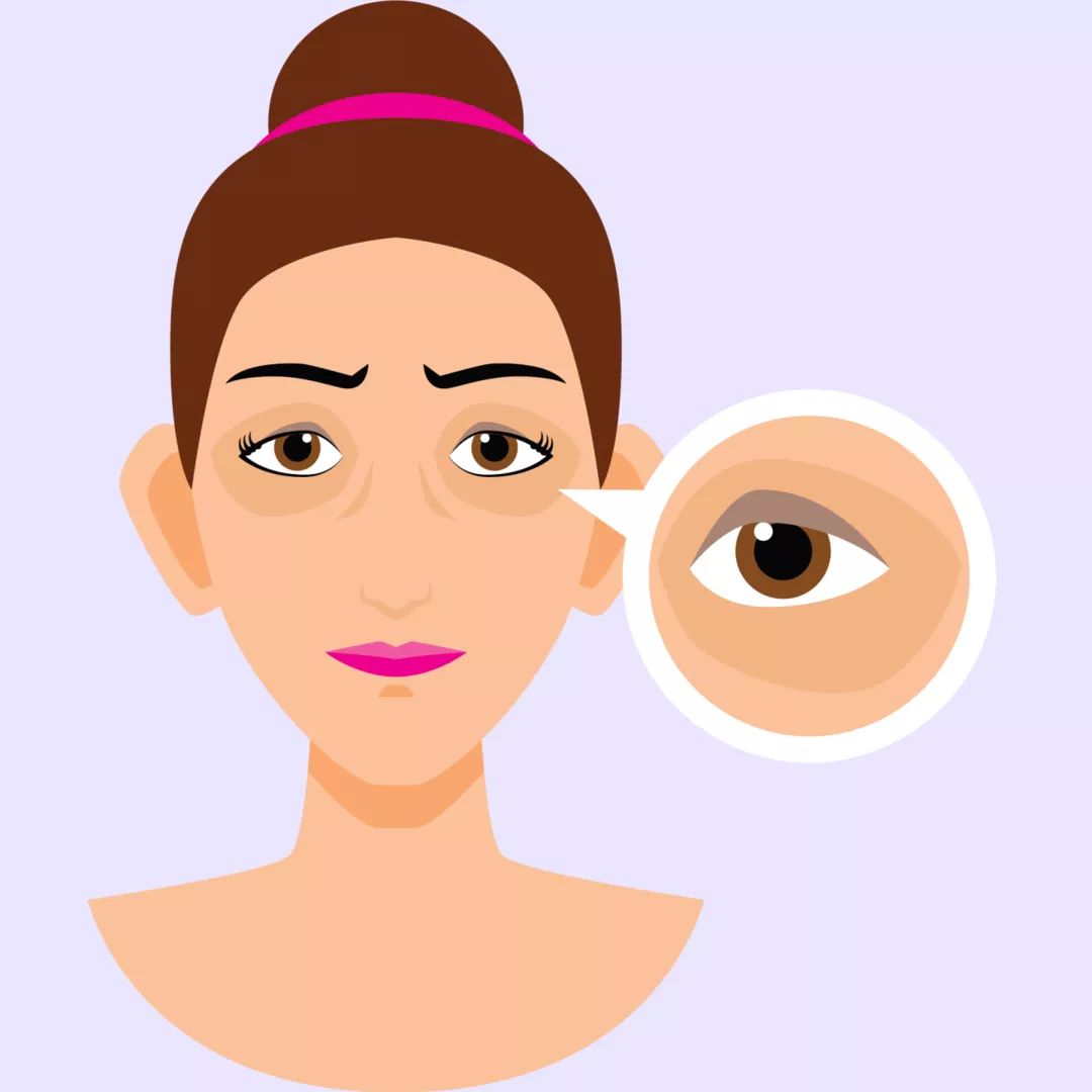 黑眼圈怎么去除最快方法,黑眼圈怎么去除最有效的方法