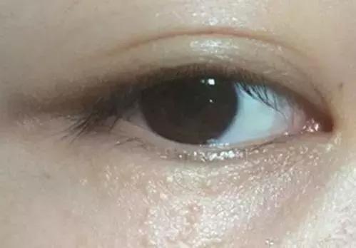 眼用红霉素软膏的功能与主治,眼睛布满血丝眼屎多用红霉素软膏