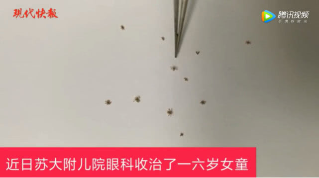 女子眼睛痒从睫毛揪出17条虫子,儿童眼睛痒是体内有虫吗