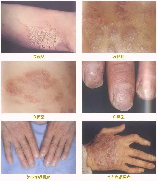 「二院技术」出*麻疹荨**满脸红痕这些皮肤病会“秋后算账”