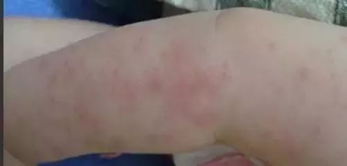 秋季孩子身上痒是什么原因,秋季宝宝身上起红疙瘩越挠越痒