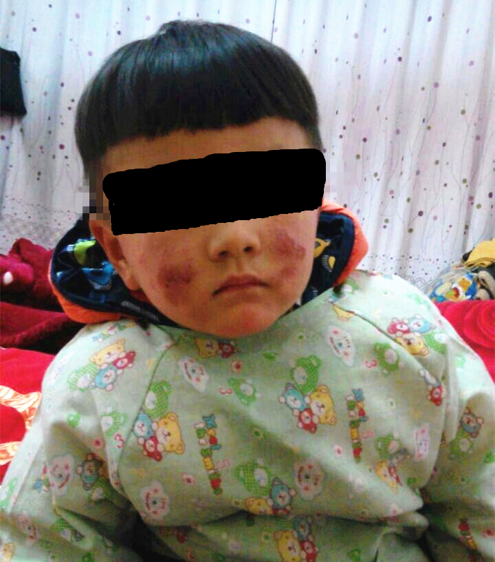 宝宝过敏性湿疹一直出脓水怎么办,宝宝湿疹用药期间反复渗水