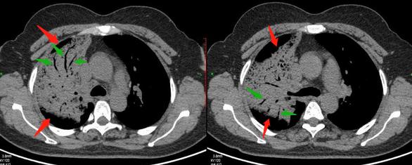 13岁女孩咳嗽半个月确定肺癌,咳嗽一个多月肺癌还有救吗