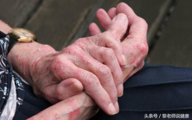 湿疹想要止痒一招帮你搞定,湿疹的止痒绝招不用药