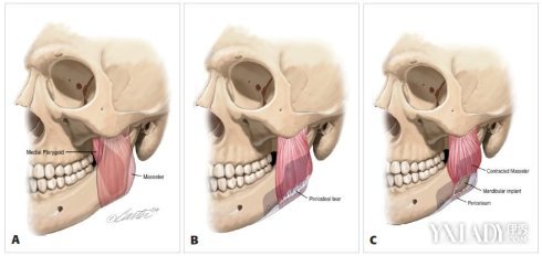 脸大该怎么解决,脸部咬肌大怎么瘦脸最有效