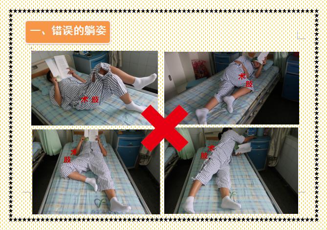 人工股骨头置换术术后教学查房,人工髋关节置换术后护理注意事项