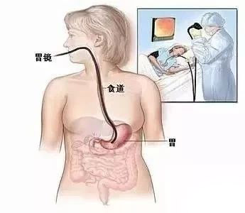 胃镜检查胶囊内镜好吗,胃镜胶囊胃镜钡餐有什么区别