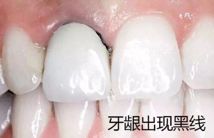 烤瓷牙与全瓷牙价格相差近十倍?究竟贵在哪?