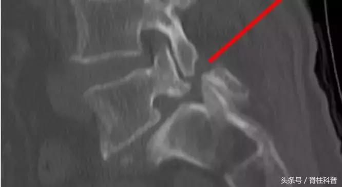 腰腿疼的防治误区,腰腿侧边疼怎么自测