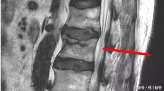 腰腿疼的防治误区,腰腿侧边疼怎么自测