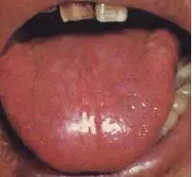 7种舌头暗示健康问题,各种病症舌头的颜色