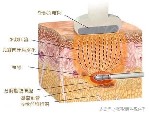 激光溶脂瘦脸要做几次效果最好,激光溶脂瘦脸多久见效