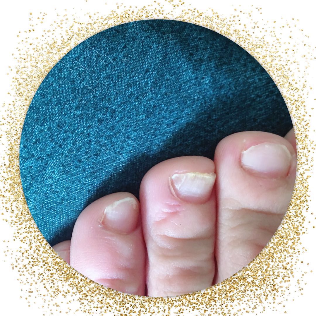 灰指甲的困扰讲述,自己亲自治好灰指甲的经历