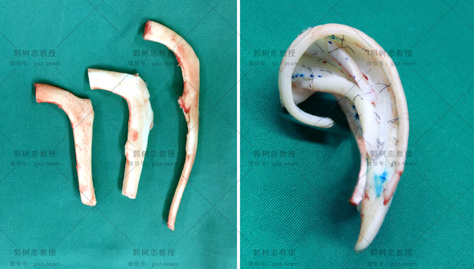 小耳再造后的耳朵,小耳畸形再造新方法