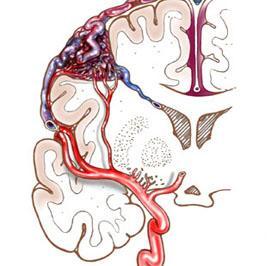 简述颅内动静脉畸形的临床表现,颅内动静脉血管畸形指南