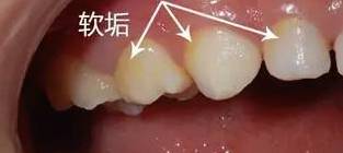 儿童口腔不良习惯的危害和防治,小孩嘴巴臭臭的是消化不良吗