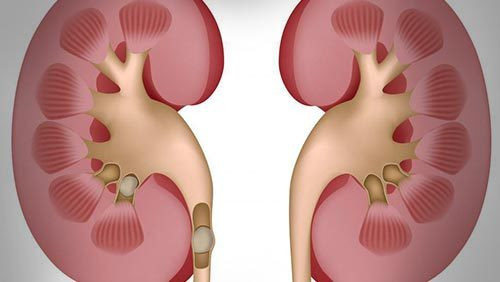 引起血尿的疾病及发病机制,引起血尿的原因有哪些