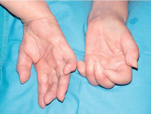 肌肉骨骼疾病的表现是什么,出现骨头疼会是癌吗