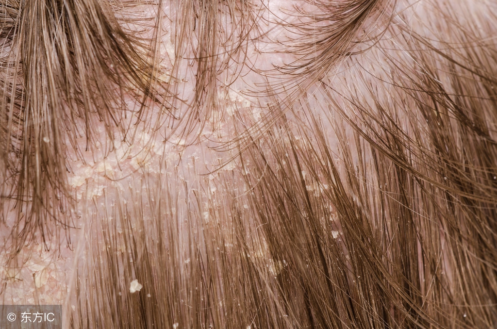 头皮屑每天太多怎么办,头皮屑太多了洗头发加什么洗