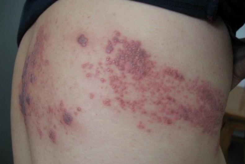 带状疱疹后遗症针灸治疗穴位,针灸火罐治疗带状疱疹