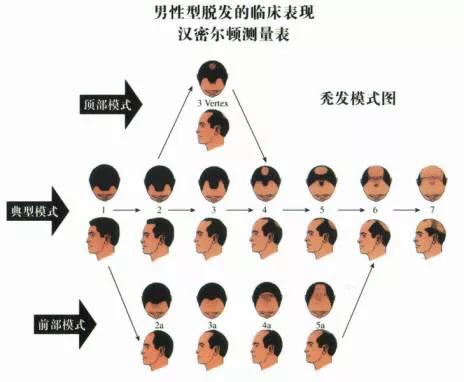 发量暴增的5个方法防脱发,脱发的两种类型怎么分别