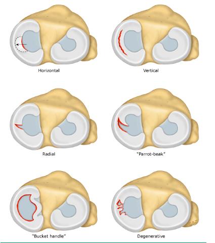 半月板需要了解哪些,收藏半月板