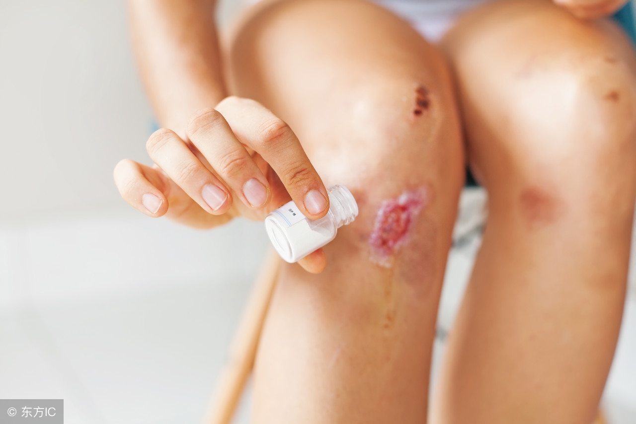 剖腹产伤口可用碘伏消毒吗,剖腹产伤口如何用碘伏消毒