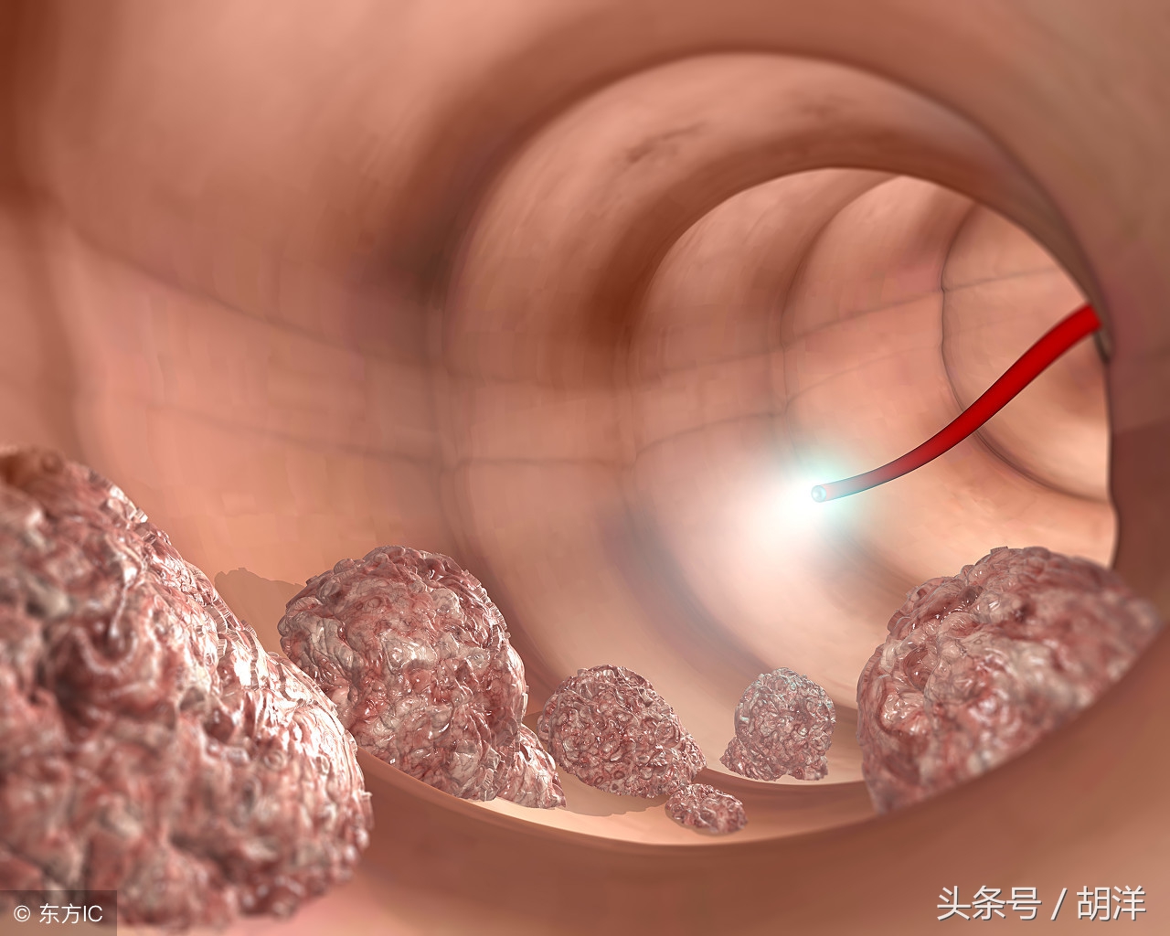 查出癌前病变什么意思,查出癌前几级需要立即手术