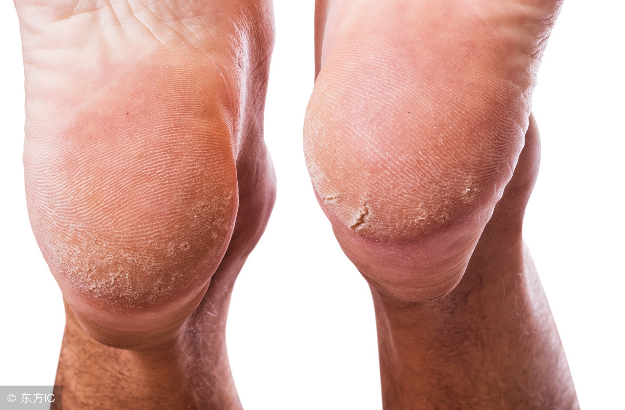 小腿后跟干裂起鱼鳞是什么原因,脚后跟像鱼鳞一样一层层干裂图